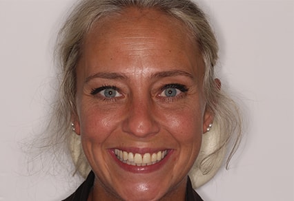 After Invisalign Treatment Smile Rooms Glasgow After Invisalign Treatment Smile Rooms Glasgow