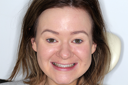 After Invisalign Treatment Smile Rooms Glasgow After Invisalign Treatment Smile Rooms Glasgow