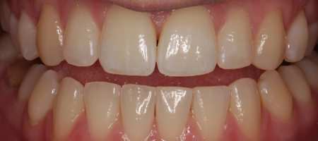 After Invisalign Treatment Smile Rooms Glasgow After Invisalign Treatment Smile Rooms Glasgow