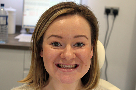 Before Invisalign Treatment Smile Rooms Glasgow Before Invisalign Treatment Smile Rooms Glasgow