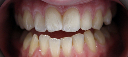 Before Invisalign Treatment Smile Rooms Glasgow Before Invisalign Treatment Smile Rooms Glasgow