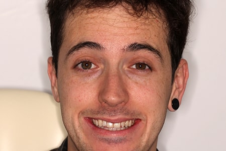 After Smile Makeover Treatment Smile Rooms Glasgow After Smile Makeover Treatment Smile Rooms Glasgow