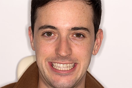 Before Smile Makeover Treatment Smile Rooms Glasgow Before Smile Makeover Treatment Smile Rooms Glasgow