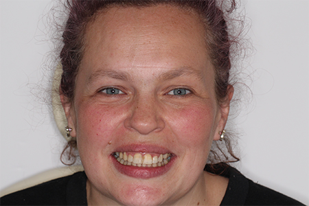 After Invisalign Treatment Smile Rooms Glasgow After Invisalign Treatment Smile Rooms Glasgow