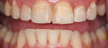 After Invisalign Treatment Smile Rooms Glasgow After Invisalign Treatment Smile Rooms Glasgow
