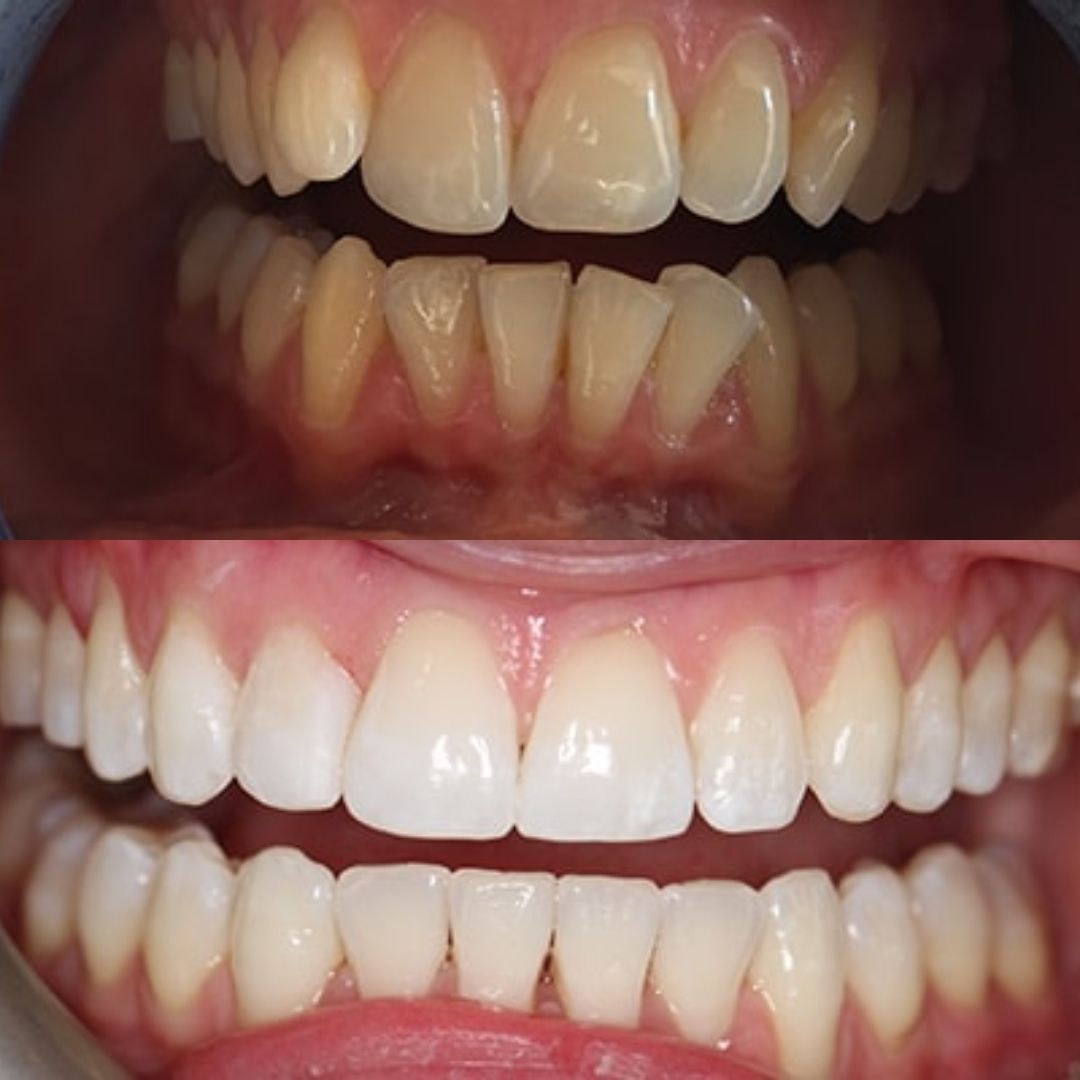 reading invisalign before after case 1