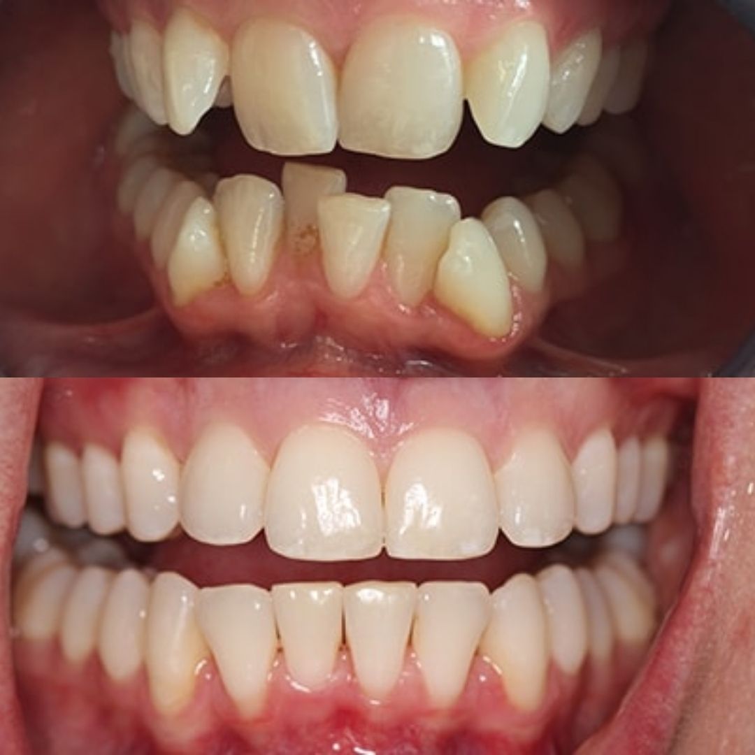 reading-invisalign-before-after-case