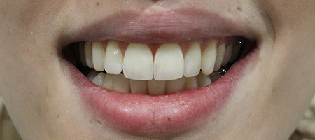 After Smile Makeover Treatment Smile Rooms Glasgow After Smile Makeover Treatment Smile Rooms Glasgow