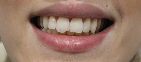 Before Smile Makeover Treatment Smile Rooms Glasgow Before Smile Makeover Treatment Smile Rooms Glasgow