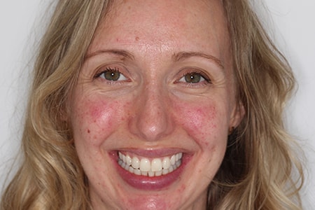 After Invisalign Treatment Smile Rooms Glasgow After Invisalign Treatment Smile Rooms Glasgow