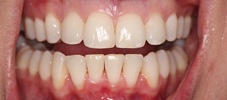 After Invisalign Treatment Smile Rooms Glasgow After Invisalign Treatment Smile Rooms Glasgow