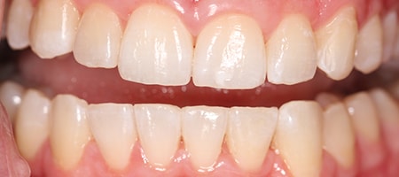 After Invisalign Treatment Smile Rooms Glasgow After Invisalign Treatment Smile Rooms Glasgow