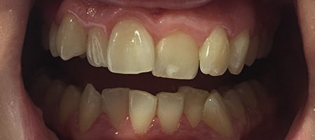 Before Invisalign Treatment Smile Rooms Glasgow Before Invisalign Treatment Smile Rooms Glasgow