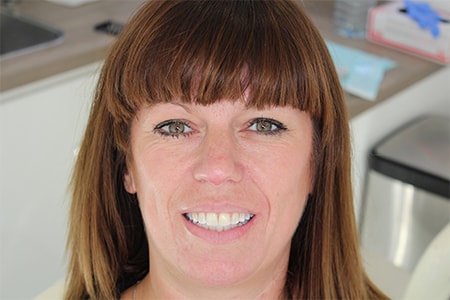 After Invisalign Treatment Smile Rooms Glasgow After Invisalign Treatment Smile Rooms Glasgow