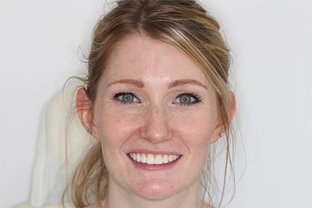 After Invisalign Treatment Smile Rooms Glasgow After Invisalign Treatment Smile Rooms Glasgow
