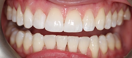 After Invisalign Treatment Smile Rooms Glasgow After Invisalign Treatment Smile Rooms Glasgow