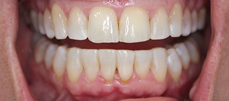 After Invisalign Treatment Smile Rooms Glasgow After Invisalign Treatment Smile Rooms Glasgow