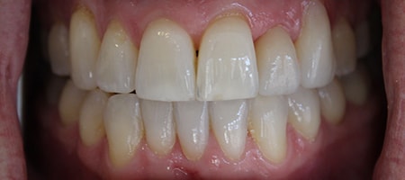 After Invisalign Treatment Smile Rooms Glasgow After Invisalign Treatment Smile Rooms Glasgow