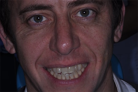 Before Invisalign Treatment Smile Rooms Glasgow Before Invisalign Treatment Smile Rooms Glasgow