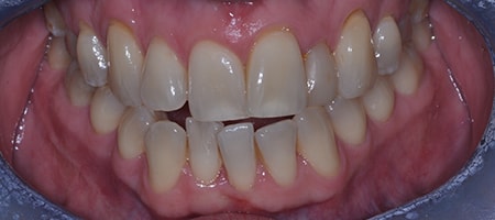 Before Invisalign Treatment Smile Rooms Glasgow Before Invisalign Treatment Smile Rooms Glasgow