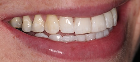 After Invisalign Treatment Smile Rooms Glasgow After Invisalign Treatment Smile Rooms Glasgow