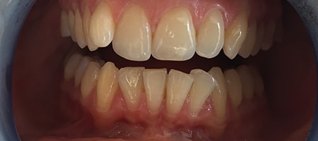 Before Invisalign Treatment Smile Rooms Glasgow Before Invisalign Treatment Smile Rooms Glasgow
