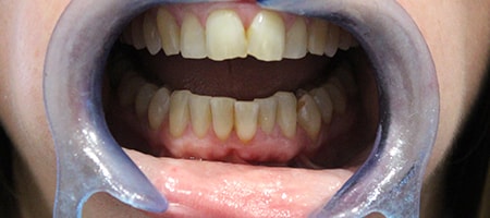 Before Invisalign Treatment Smile Rooms Glasgow Before Invisalign Treatment Smile Rooms Glasgow