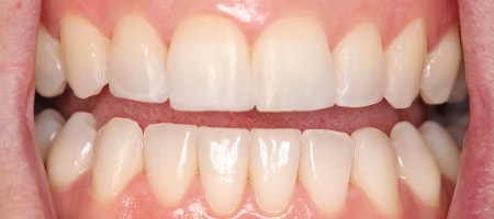 After Invisalign Treatment Smile Rooms Glasgow After Invisalign Treatment Smile Rooms Glasgow