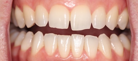Before Invisalign Treatment Smile Rooms Glasgow Before Invisalign Treatment Smile Rooms Glasgow