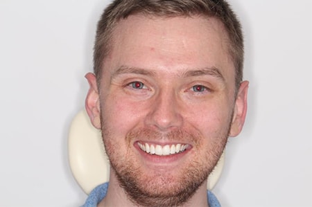 After Invisalign Treatment Smile Rooms Glasgow After Invisalign Treatment Smile Rooms Glasgow