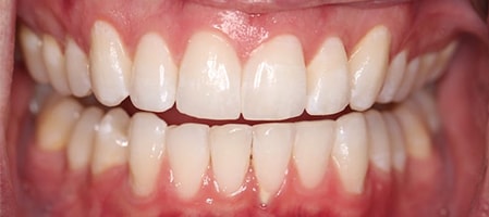 After Invisalign Treatment Smile Rooms Glasgow After Invisalign Treatment Smile Rooms Glasgow