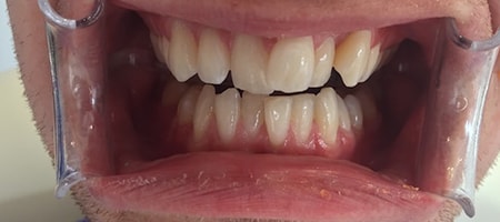 Before Invisalign Treatment Smile Rooms Glasgow Before Invisalign Treatment Smile Rooms Glasgow
