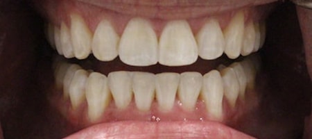 After Invisalign Treatment Smile Rooms Glasgow After Invisalign Treatment Smile Rooms Glasgow