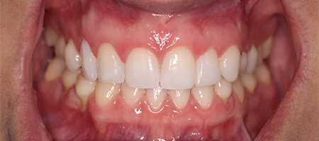 After Invisalign Treatment Smile Rooms Glasgow After Invisalign Treatment Smile Rooms Glasgow