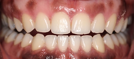 After Invisalign Treatment Smile Rooms Glasgow After Invisalign Treatment Smile Rooms Glasgow