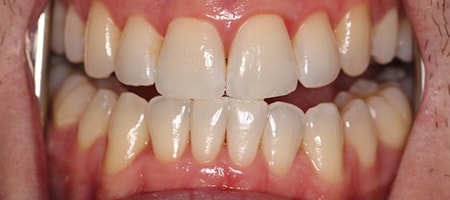 After Invisalign Treatment Smile Rooms Glasgow After Invisalign Treatment Smile Rooms Glasgow