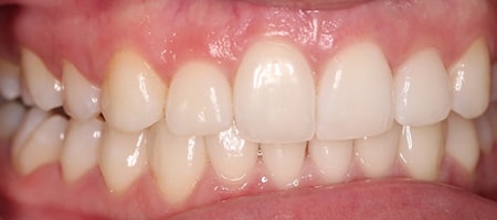 After Invisalign Treatment Smile Rooms Glasgow After Invisalign Treatment Smile Rooms Glasgow