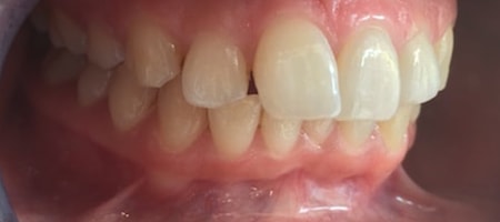 Before Invisalign Treatment Smile Rooms Glasgow Before Invisalign Treatment Smile Rooms Glasgow