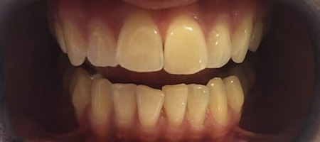 Before Invisalign Treatment Smile Rooms Glasgow Before Invisalign Treatment Smile Rooms Glasgow
