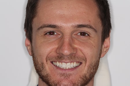 After Invisalign Treatment Smile Rooms Glasgow After Invisalign Treatment Smile Rooms Glasgow