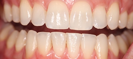 After Invisalign Treatment Smile Rooms Glasgow After Invisalign Treatment Smile Rooms Glasgow