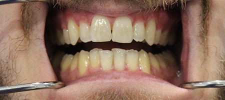 Before Invisalign Treatment Smile Rooms Glasgow Before Invisalign Treatment Smile Rooms Glasgow