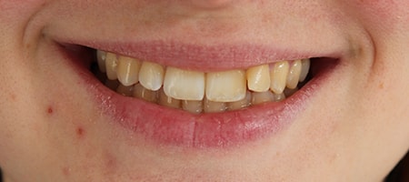 Before Invisalign Treatment Smile Rooms Glasgow Before Invisalign Treatment Smile Rooms Glasgow