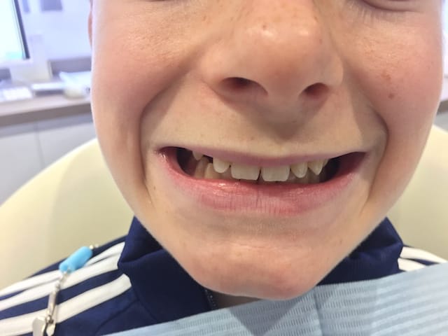 reading-smiles-invisalign-teenager-b1