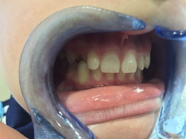 reading-smiles-invisalign-teenager-b2