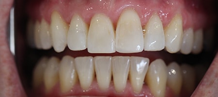 After Invisalign Treatment Smile Rooms Glasgow After Invisalign Treatment Smile Rooms Glasgow