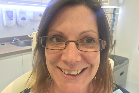 Before Invisalign Treatment Smile Rooms Glasgow Before Invisalign Treatment Smile Rooms Glasgow