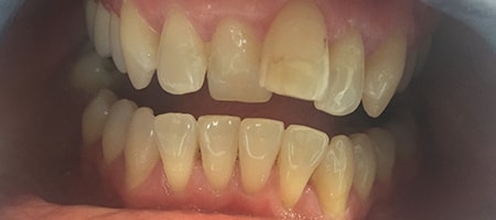Before Invisalign Treatment Smile Rooms Glasgow Before Invisalign Treatment Smile Rooms Glasgow