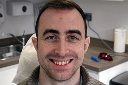 Before Invisalign Treatment Smile Rooms Glasgow Before Invisalign Treatment Smile Rooms Glasgow