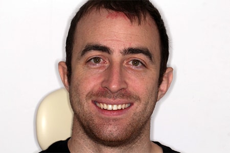 After Invisalign Treatment Smile Rooms Glasgow After Invisalign Treatment Smile Rooms Glasgow